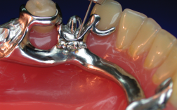 partial extension
